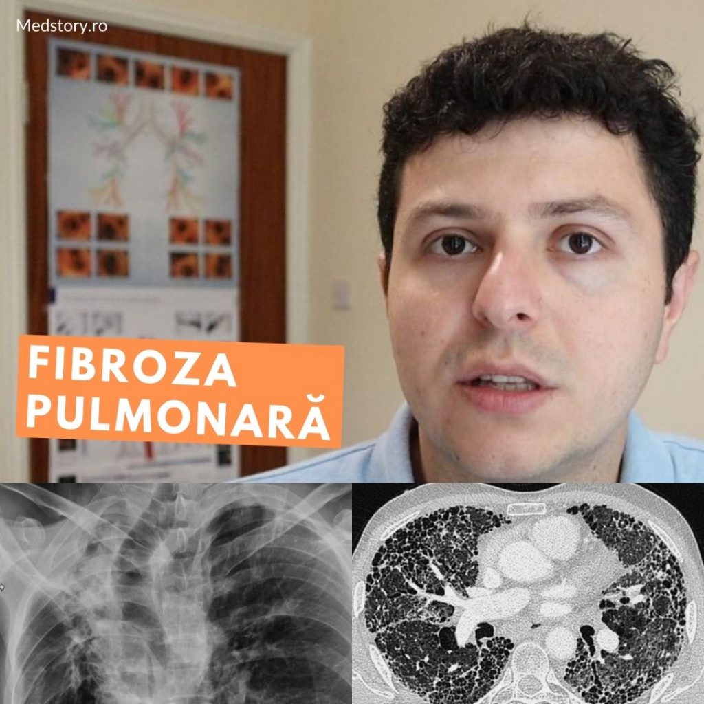 Fibroza Pulmonară - rafinament-club.ro